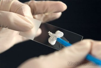 За шесть лет заболеваемость раком шейки матки снизилась на треть