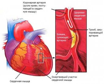Украинские медики ежегодно диагностируют 50 тыс. острых инфарктов миокарда и 50 тыс. инсультов