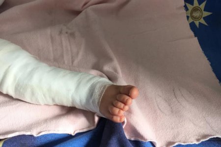В Одессе спасают ребенка, получившего ожоги 80 % тела